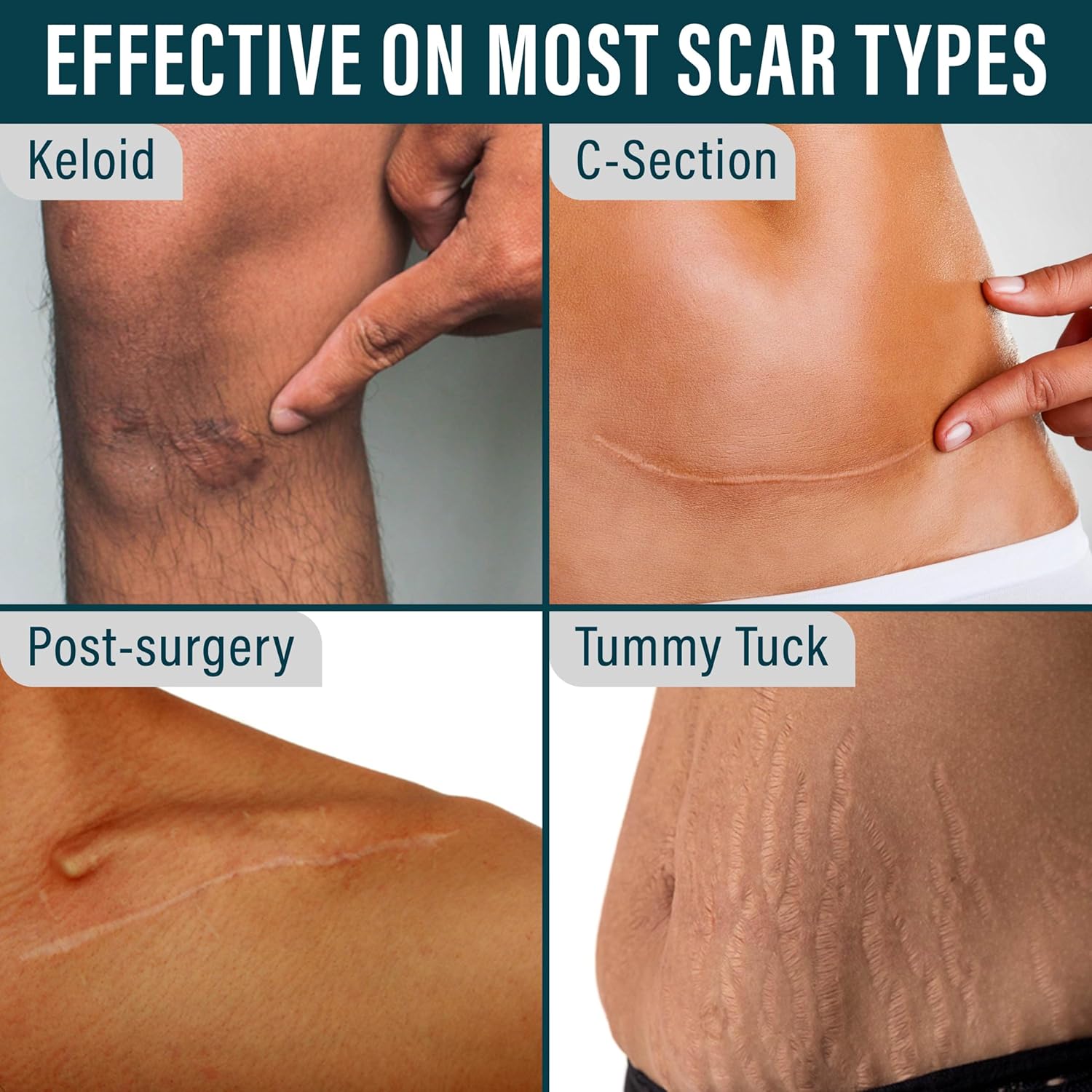 Silicone Scar Tape