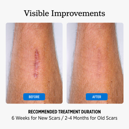 Silicone Scar Tape